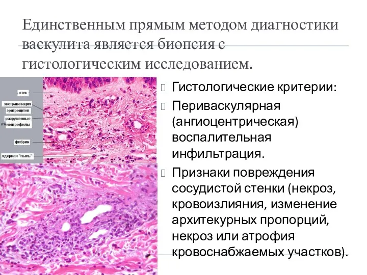 Единственным прямым методом диагностики васкулита является биопсия с гистологическим исследованием.