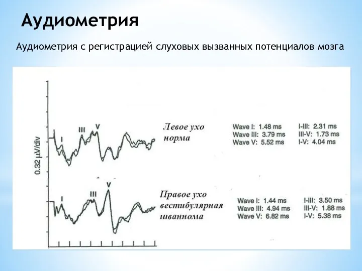 Аудиометрия Аудиометрия с регистрацией слуховых вызванных потенциалов мозга