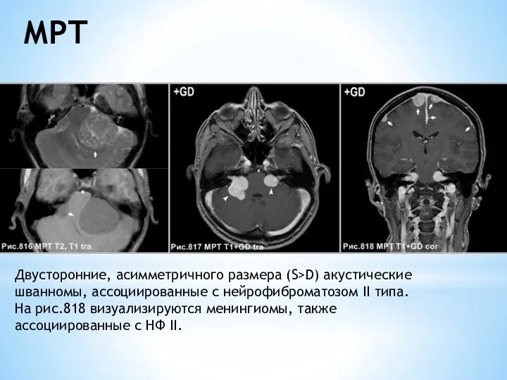 МРТ Двусторонние, асимметричного размера (S>D) акустические шванномы, ассоциированные с нейрофиброматозом