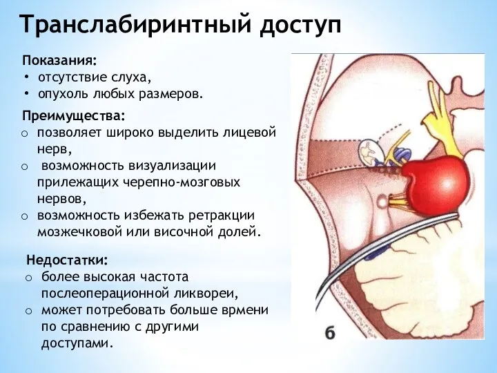 Транслабиринтный доступ Показания: отсутствие слуха, опухоль любых размеров. Преимущества: позволяет