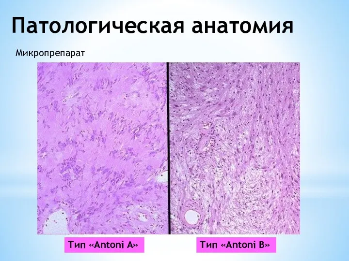 Патологическая анатомия Микропрепарат Тип «Antoni A» Тип «Antoni B»