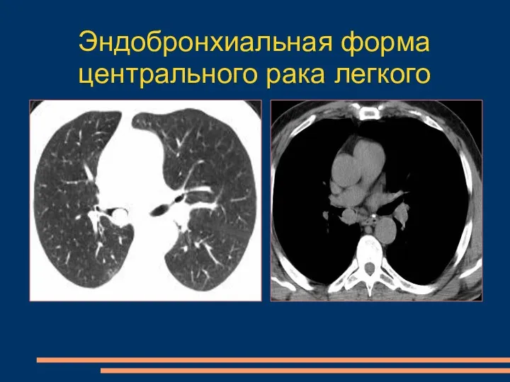 Эндобронхиальная форма центрального рака легкого