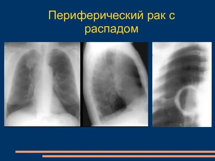 Периферический рак с распадом