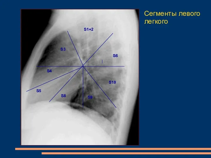Сегменты левого легкого S1+2 S3 S4 S8 S5 S9 S6 S10