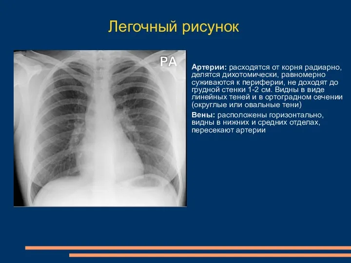 Легочный рисунок Артерии: расходятся от корня радиарно, делятся дихотомически, равномерно