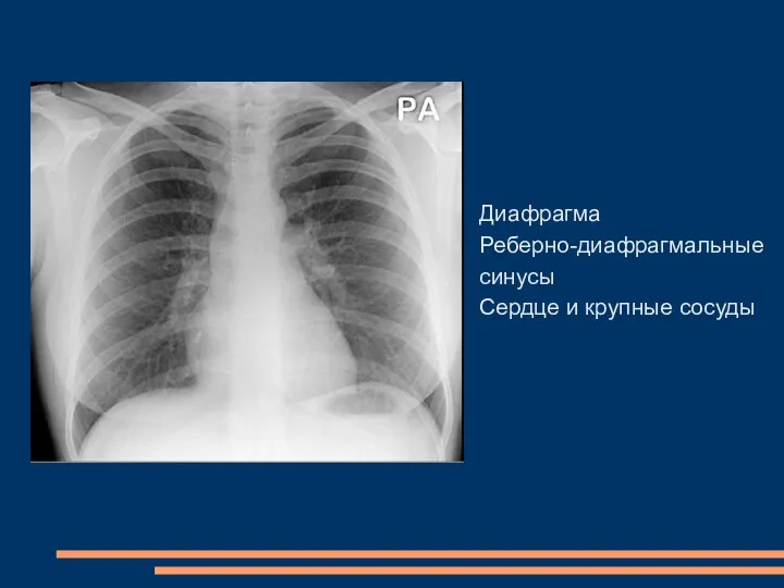 Диафрагма Реберно-диафрагмальные синусы Сердце и крупные сосуды