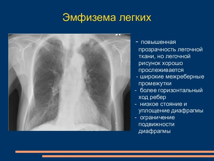 Эмфизема легких - повышенная прозрачность легочной ткани, но легочной рисунок