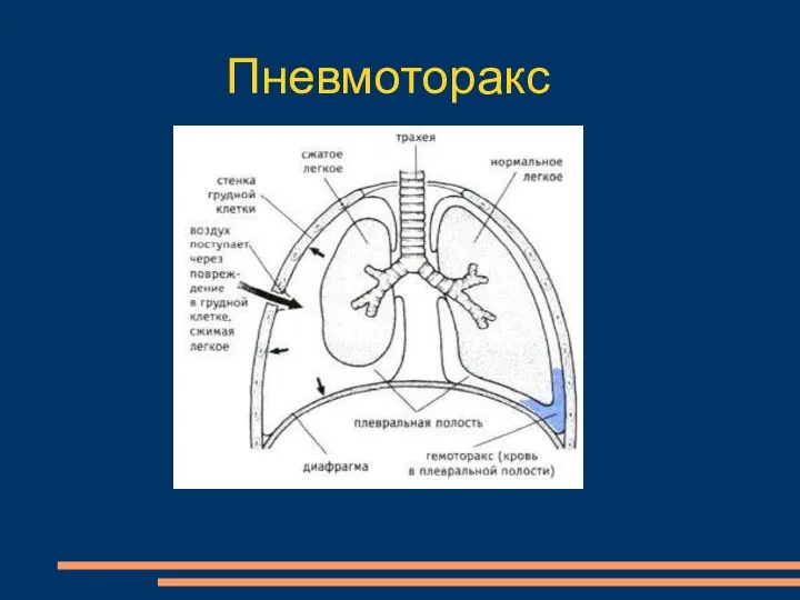 Пневмоторакс