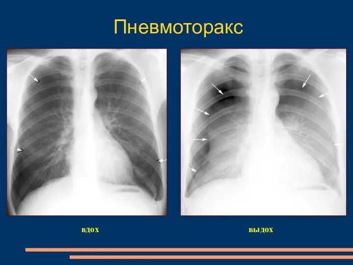 вдох выдох Пневмоторакс