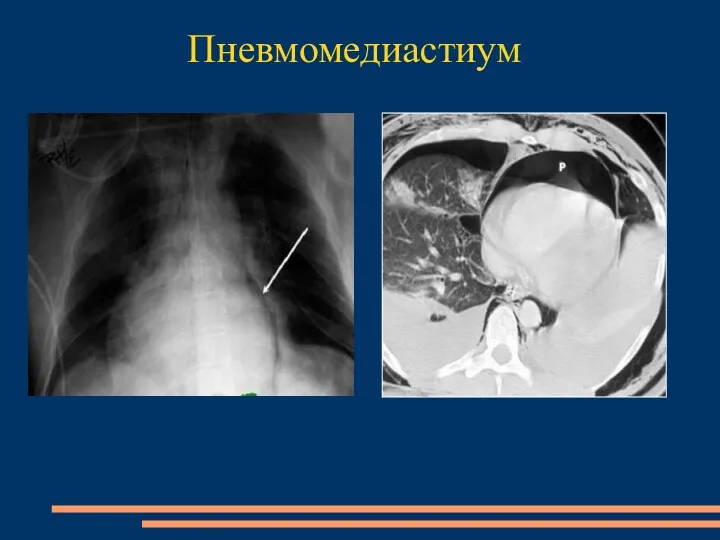 Пневмомедиастиум