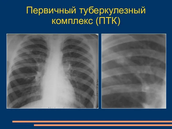 Первичный туберкулезный комплекс (ПТК)