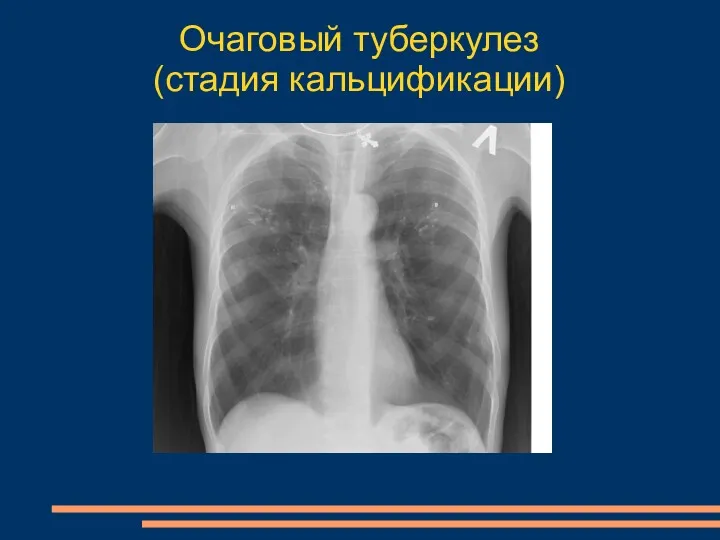 Очаговый туберкулез (стадия кальцификации)