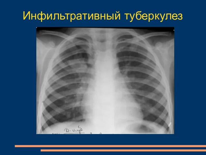 Инфильтративный туберкулез