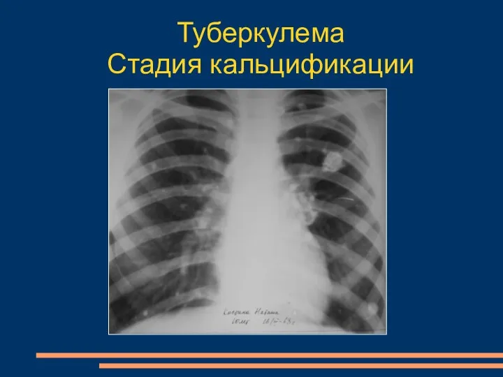 Туберкулема Стадия кальцификации