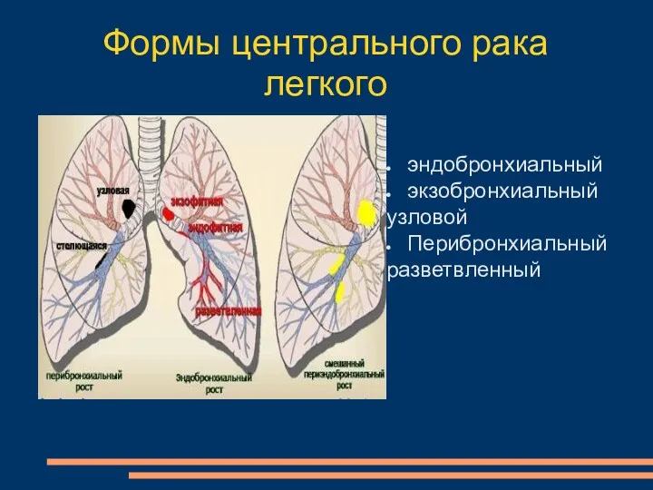 Формы центрального рака легкого эндобронхиальный экзобронхиальный узловой Перибронхиальный разветвленный