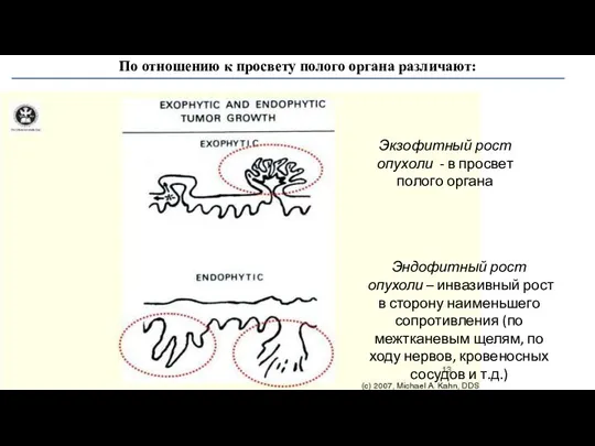 Экзофитный рост опухоли - в просвет полого органа Эндофитный рост