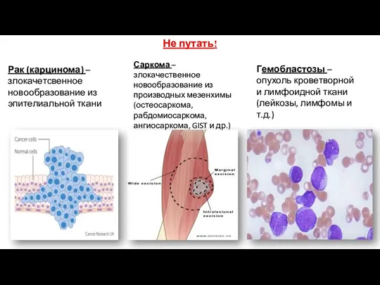 Рак (карцинома) – злокачетсвенное новообразование из эпителиальной ткани Саркома –