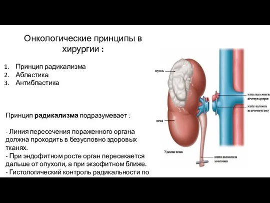 Онкологические принципы в хирургии : Принцип радикализма Абластика Антибластика Принцип