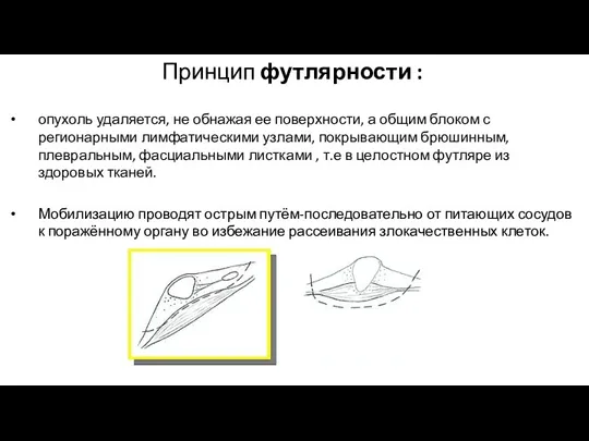 Принцип футлярности : опухоль удаляется, не обнажая ее поверхности, а