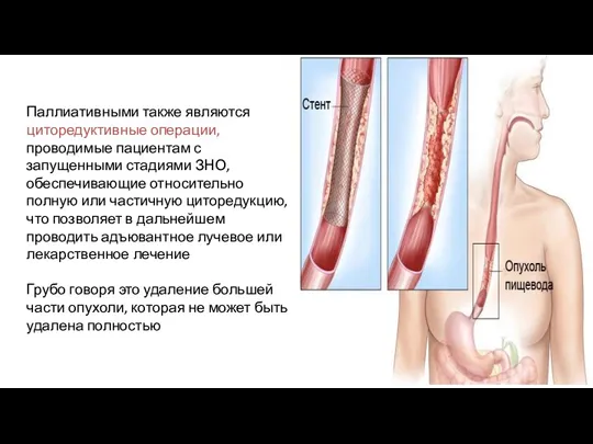 Паллиативными также являются циторедуктивные операции, проводимые пациентам с запущенными стадиями