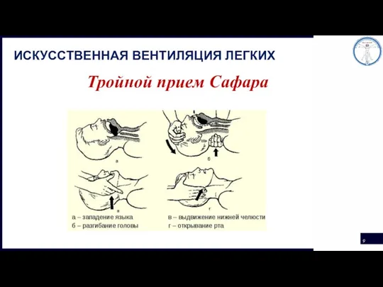 ИСКУССТВЕННАЯ ВЕНТИЛЯЦИЯ ЛЕГКИХ Тройной прием Сафара