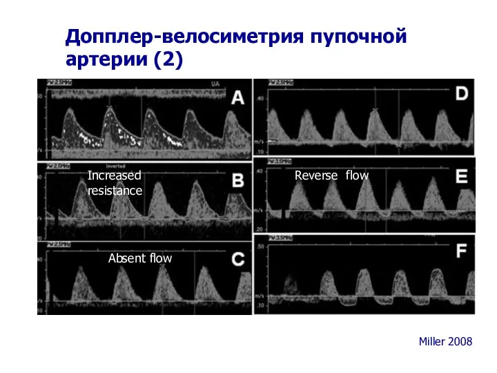 Допплер-велосиметрия пупочной артерии (2) Miller 2008 Absent flow Reverse flow Increased resistance