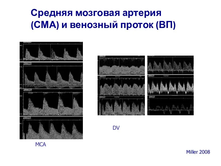 Средняя мозговая артерия (СМА) и венозный проток (ВП) MCA DV Miller 2008