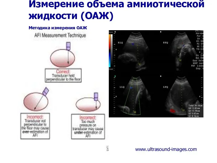 Измерение объема амниотической жидкости (ОАЖ) Методика измерения ОАЖ www.ultrasound-images.com