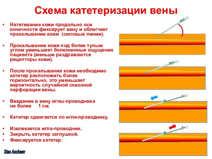 Схема катетеризации вены Натягивание кожи продольно оси конечности фиксирует вену