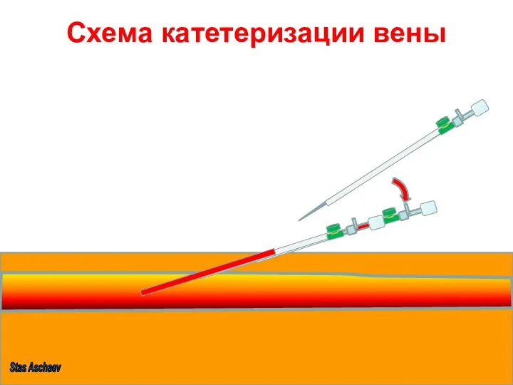 Схема катетеризации вены Stas Aschaev