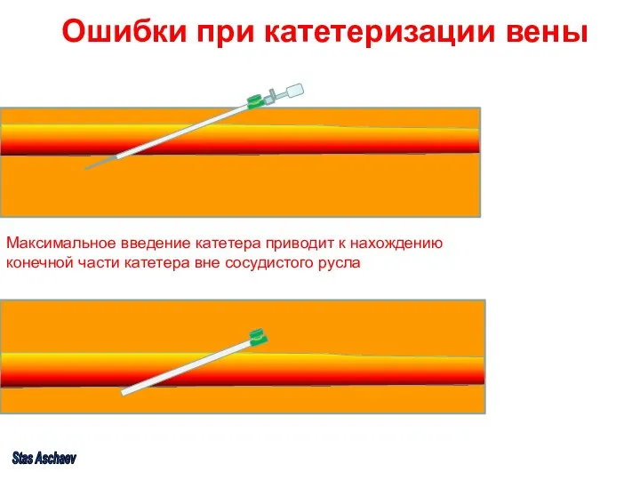 Ошибки при катетеризации вены Максимальное введение катетера приводит к нахождению