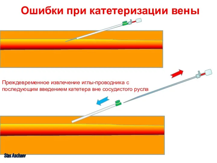 Ошибки при катетеризации вены Преждевременное извлечение иглы-проводника с последующим введением катетера вне сосудистого русла Stas Aschaev