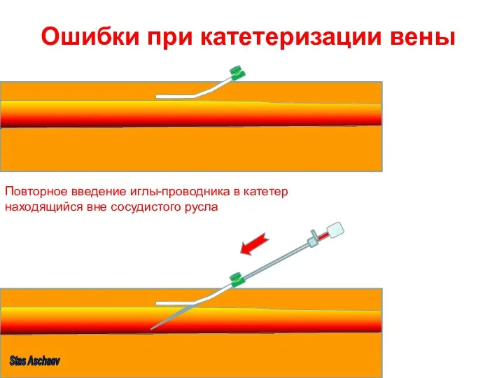Ошибки при катетеризации вены Повторное введение иглы-проводника в катетер находящийся вне сосудистого русла Stas Aschaev