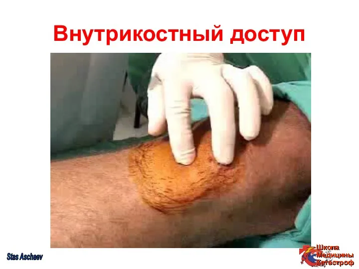 Внутрикостный доступ Stas Aschaev