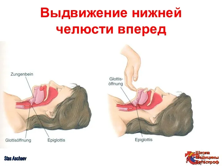 Выдвижение нижней челюсти вперед Stas Aschaev