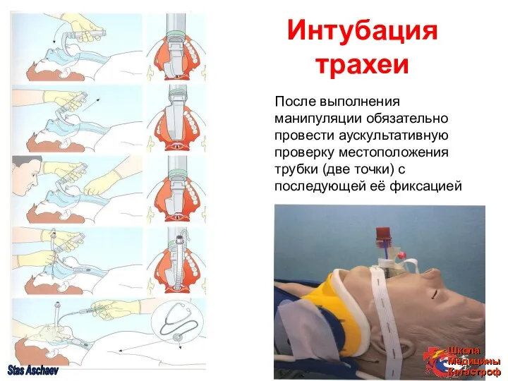 Интубация трахеи После выполнения манипуляции обязательно провести аускультативную проверку местоположения