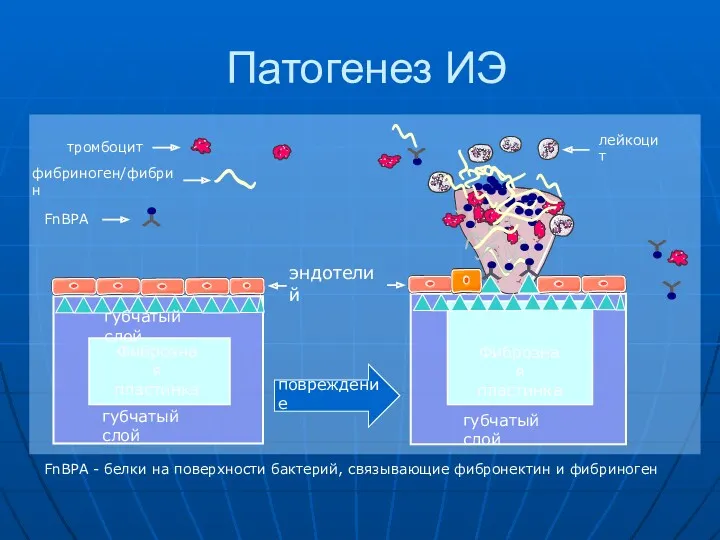 Патогенез ИЭ повреждение Фиброзная пластинка Фиброзная пластинка губчатый слой губчатый