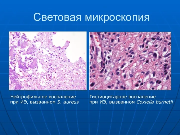 Световая микроскопия Нейтрофильное воспаление при ИЭ, вызванном S. aureus Гистиоцитарное воспаление при ИЭ, вызванном Coxiella burnetii