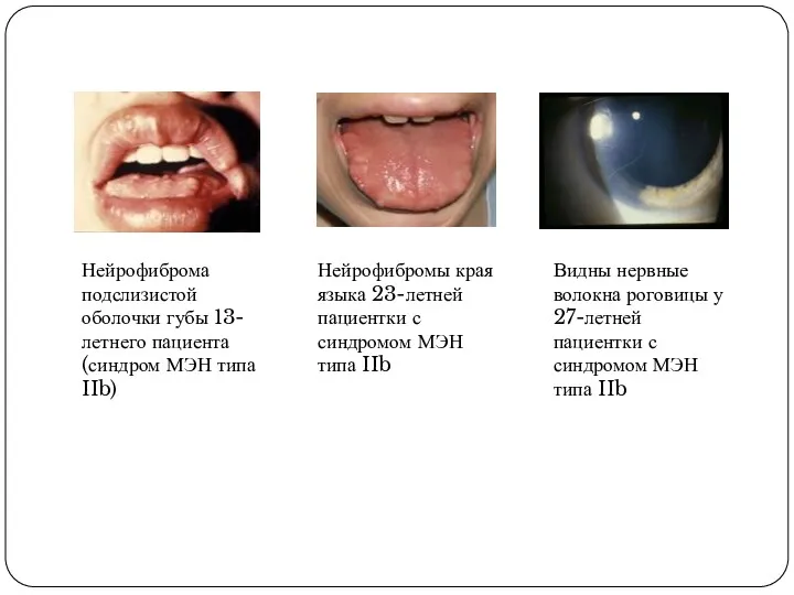 Нейрофиброма подслизистой оболочки губы 13-летнего пациента (синдром МЭН типа IIb) Нейрофибромы края языка