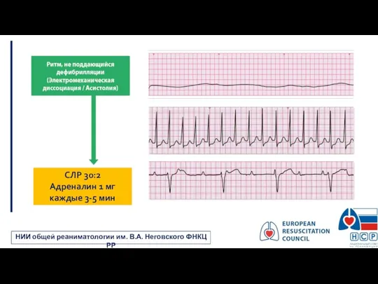 СЛР 30:2 Адреналин 1 мг каждые 3-5 мин НИИ общей реаниматологии им. В.А. Неговского ФНКЦ РР