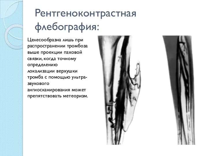 Рентгеноконтрастная флебография: Целесообразна лишь при распространении тромбоза выше проекции паховой