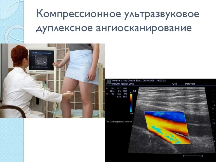 Компрессионное ультразвуковое дуплексное ангиосканирование