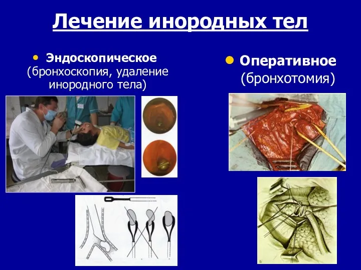 Лечение инородных тел Эндоскопическое (бронхоскопия, удаление инородного тела) Оперативное (бронхотомия)