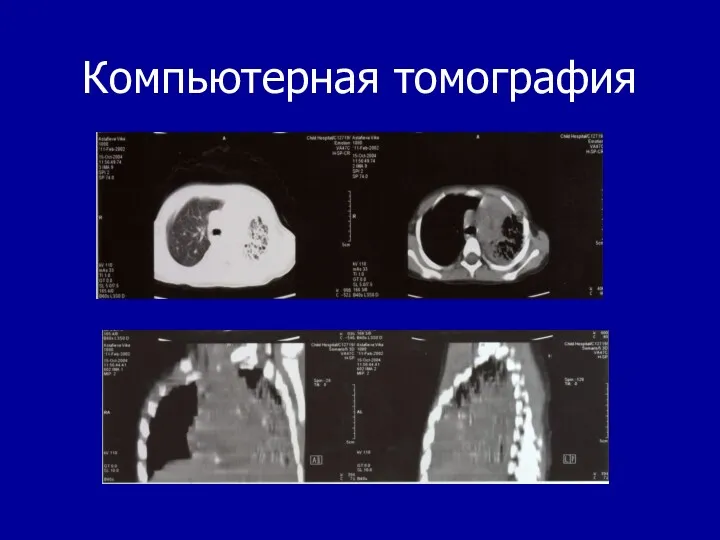 Компьютерная томография