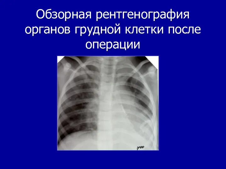 Обзорная рентгенография органов грудной клетки после операции
