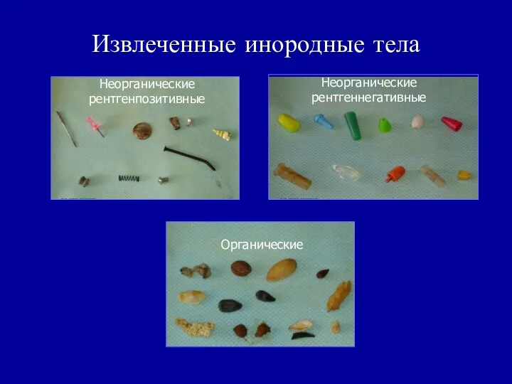 Извлеченные инородные тела Неорганические рентгенпозитивные Неорганические рентгеннегативные Органические