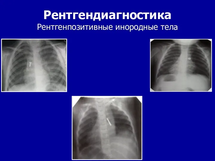 Рентгендиагностика Рентгенпозитивные инородные тела