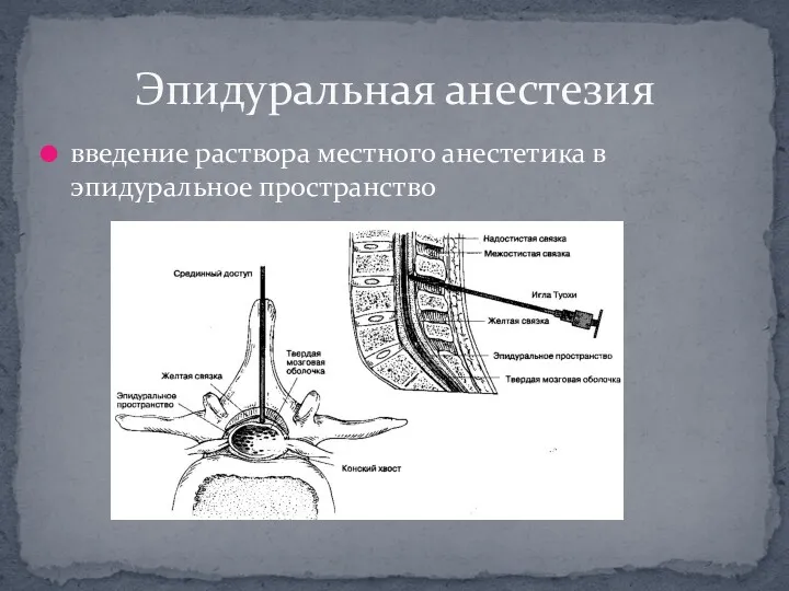 введение раствора местного анестетика в эпидуральное пространство Эпидуральная анестезия