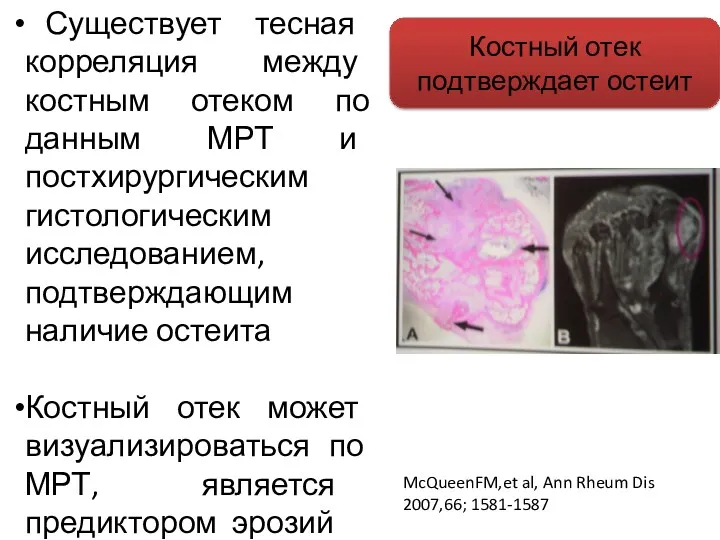 Существует тесная корреляция между костным отеком по данным МРТ и