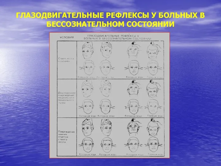 ГЛАЗОДВИГАТЕЛЬНЫЕ РЕФЛЕКСЫ У БОЛЬНЫХ В БЕССОЗНАТЕЛЬНОМ СОСТОЯНИИ